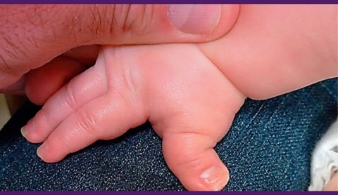 Día Internacional del Síndrome de Rubinstein-Taybi, conocido como enfermedad de los dedos gordos