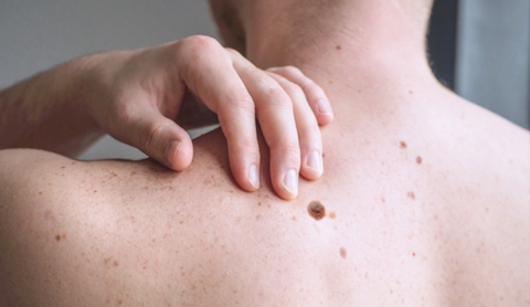 Conoce la regla ABCDE: una herramienta clave para detectar el cáncer de piel a tiempo