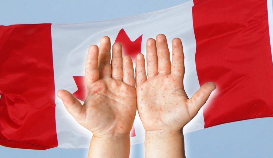 Brote de sarampión en Canadá se agrava con 223 nuevos contagios
