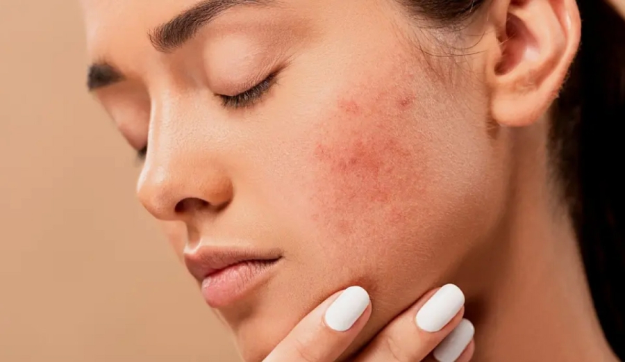Descubre qué te dicen los granos de tu rostro sobre tu salud interna