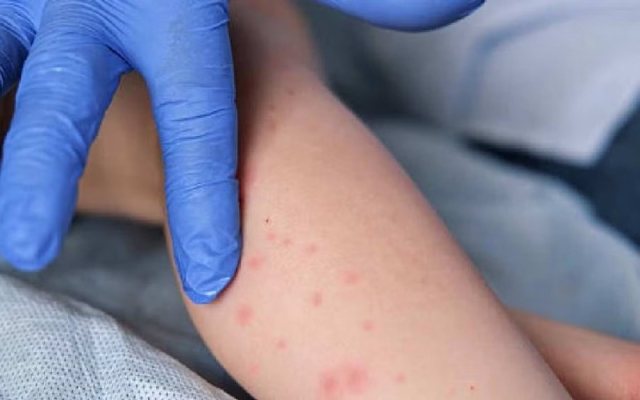 M&eacute;xico en riesgo de perder certificaci&oacute;n de pa&iacute;s libre de sarampi&oacute;n