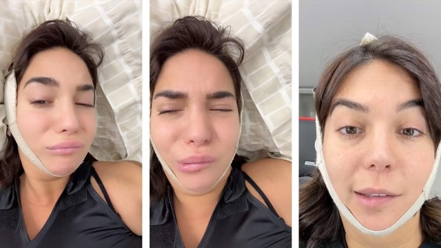 Influencer alerta: Sufre parálisis facial tras realizarse la lipopapada