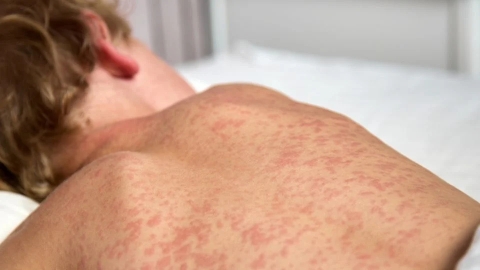 Confirman caso de sarampión en Guanajuato luego de 30 años sin contagios