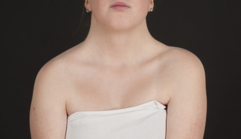 Conciencia global sobre el Síndrome de Turner y la importancia de su detección temprana