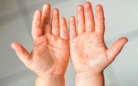 Muere otra niña no vacunada por sarampión en Texas; suman dos muertes