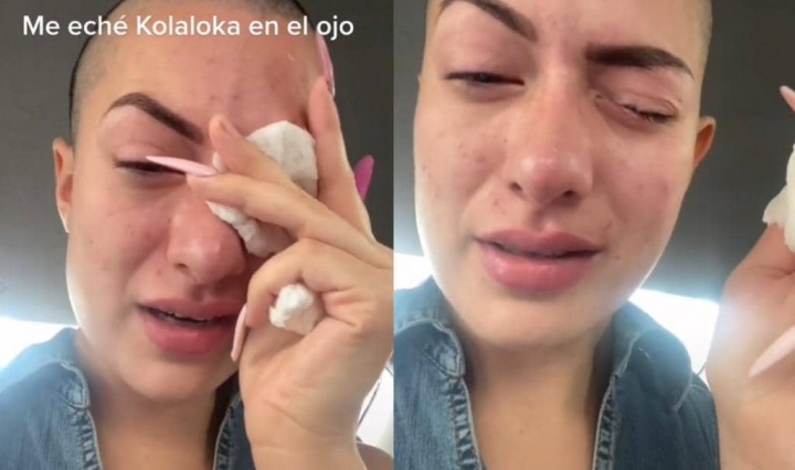 TikToker confunde gotas de los ojos con pegamento y termina en el hospital