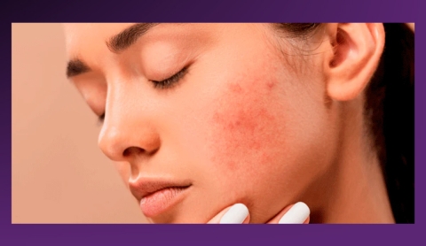 ¿Tu piel empeoró con una nueva rutina? Podría ser &#039;Skin Purging&#039;, y no lo que piensas