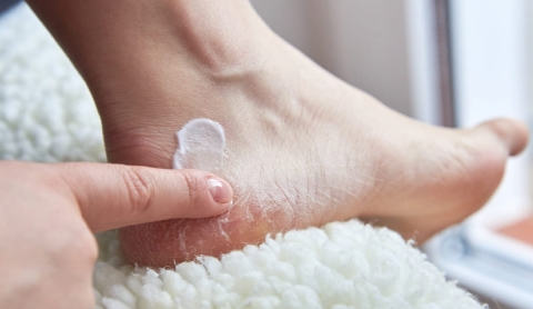 Talones agrietados: por qué ocurren y cómo tratarlos eficazmente