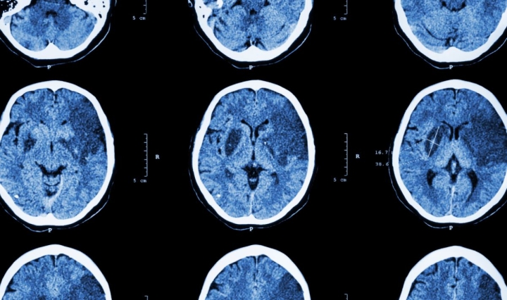 Una muestra de sangre podría revelar la recuperación de un traumatismo cerebral