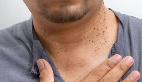 Cómo eliminar verrugas del cuello de manera segura y remedios caseros útiles