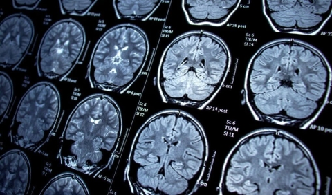 Visualizan por primera vez proteínas iniciadoras del párkinson en el cerebro