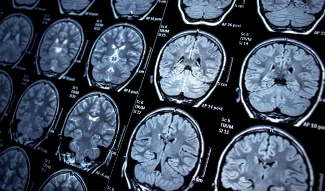 Visualizan por primera vez proteínas iniciadoras del párkinson en el cerebro