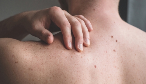 5 señales que no debes ignorar sobre el cáncer de piel