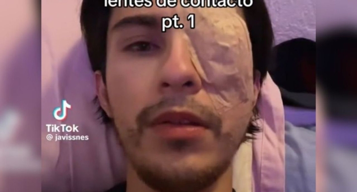 Tragedia ocular: Uso de lentes de contacto cambia vida