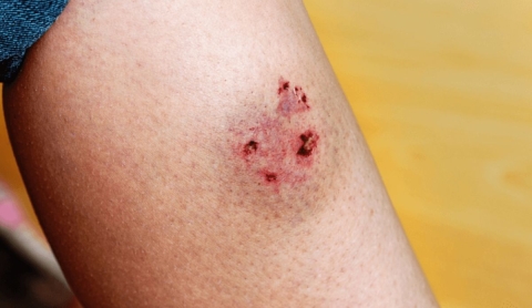 Rabia: síntomas, tiempo de aparición y medidas de prevención esenciales